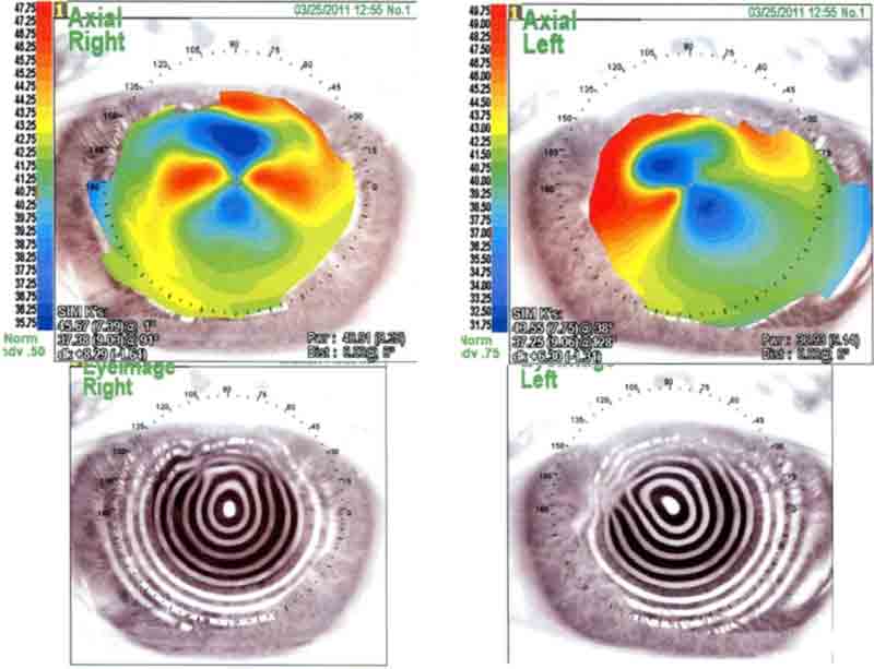 The right eye has an against the rule irregular astigmatism with superior steepening. The placido image shows irregular mires superiorly. The left eye has an asymmetric against the rule irregular astigmatism with superonasal steepening and corresponding irregular mires on placido image.