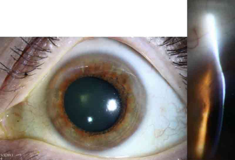 Slit lamp photo of the left eye of another patient with Salzmann's nodular corneal degeneration