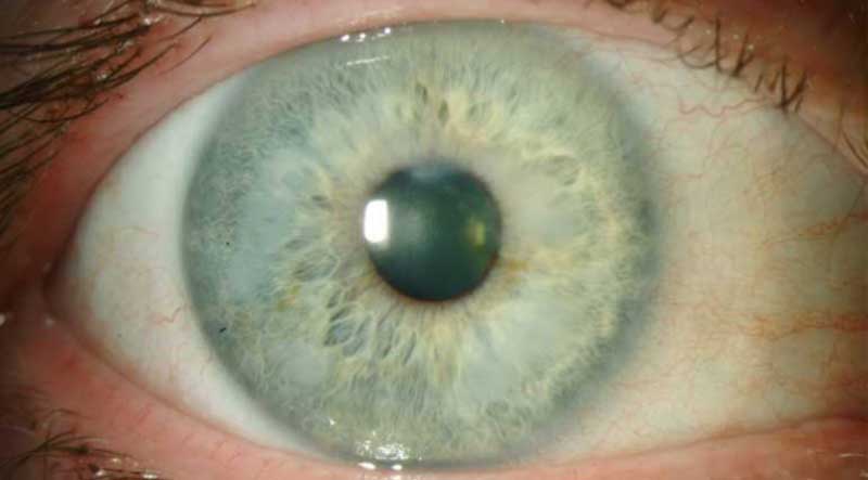 Slit lamp photo of the right eye of another patient with Salzmann's nodular corneal degeneration. Nodules are annular in the mid-periphery.