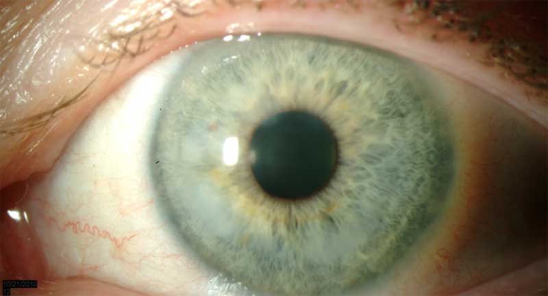 Figure 8b: Slit lamp photo of the left eye of another patient with Salzmann's nodular corneal degeneration. Nodules are annular in the interior mid-periphery.