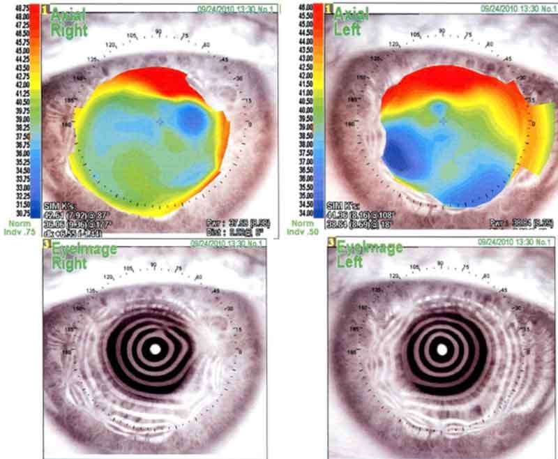 Corneal topography. The right eye shows a very irregular astigmatism with superior and nasal steepening. Placido image shows irregular mires in the mid-periphery in all directions. The left eye has a very irregular astigmatism with marked superior and temporal steepening. The placido image has irregular mires with some nasal steepening.