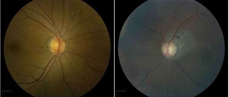 Figure 2, optic nerve examination
