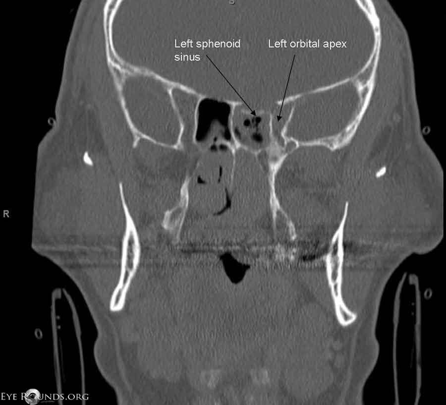 Coronal computed tomography (CT) scan showing fracture of posterolateral aspect of left sphenoid sinus in area of left optic canal