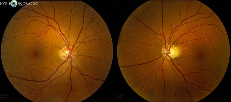 Color fundus photography showing mild pallor of the left optic nerve head