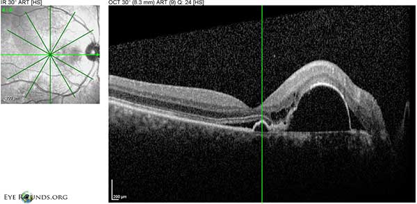 Figure 5: OD Spectralis OCT of the macula at initial presentation showing multiple PEDs with shallow SRF and mild overlying intraretinal cystic degeneration. 