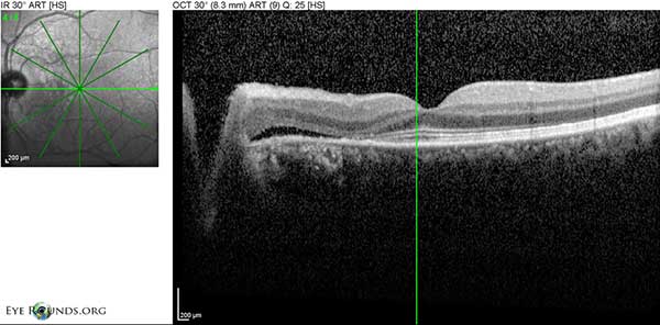 Figure 6: OS Spectralis OCT of the macula at initial presentation with shallow SRF temporal to the disc 