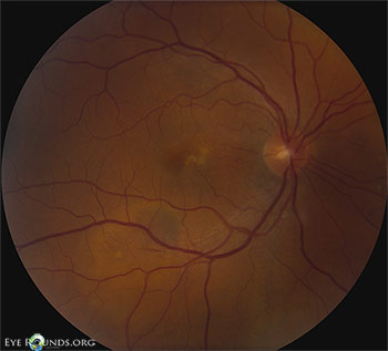 OD color fundus photograph at initial presentation showing a shallow PED nasal to fovea, SRF inferonasal to macula, and pigment clumping along inferotemporal arcade