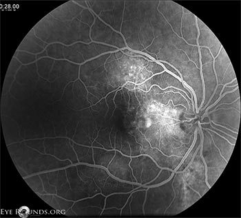 Figure 3 : OD fluorescein angiography, late frames, at initial presentation showing patchy areas of leakage in the nasal macula and along the superior and inferior arcades.
