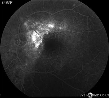Figure 4: OS fluorescein angiography, late frames, at initial presentation showing diffuse leakage in the superonasal macula.