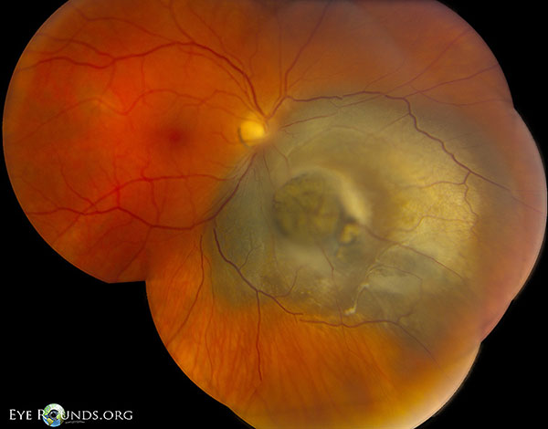 Elevated, peripapillary, moderately pigmented collar button shaped choroidal mass with mild overlying RPE metaplasia inferonasal to the optic disc.. The mass measures 14 x 11 x 6 mm and overhangs the disc. 