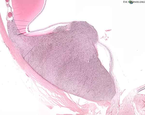Histolopathology demonstrating the choroidal melanoma which disrupts Bruch's membrane forming a "collar button" appearance