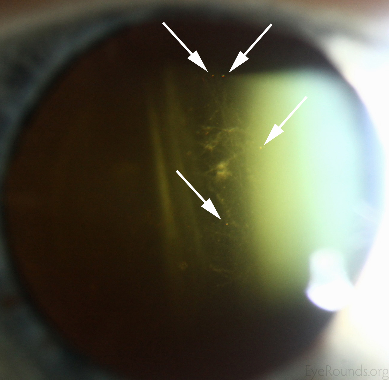 Vitreous Syneresis An Impending Posterior Vitreous Detachment PVD Vitreous Syneresis An Impending Posterior Vitreous Detachment PVD