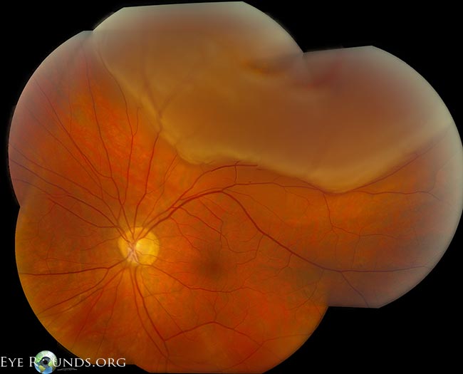 High magnification of a peripheral horseshoe retinal tear adjacent to lattice degeneration, a retinal vessel, and specks of intraretinal hemorrhage