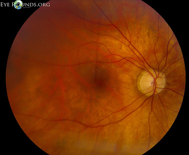 Low magnification montage, rhegmatogenous macula-off retinal detachment