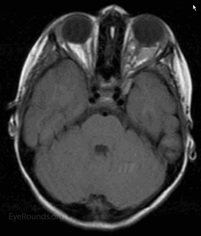 Axial T1 image showing left multicystic, intraconal mass with an amorphous shape and internal sepations. Minute fluid-fluid levels were appreciated by the neuro-radiology team as well as extension of the mass through the superior orbital fissure into the left cavernous sinus.