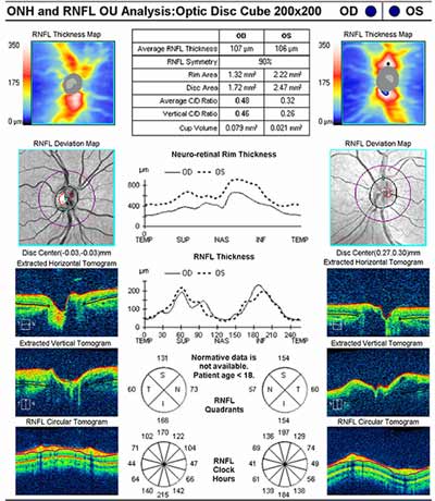 Cirrus Optical Coherence Tomography showed no optic nerve edema and normal retinal nerve fiber layer.