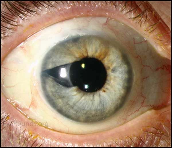 Superior and temporal tube well covered by conjunctiva and donor cornea. The tube enters the anterior chamber over the area iridectomy to decrease the potential of abnormal cells endothelial cells from occluding the tube. 