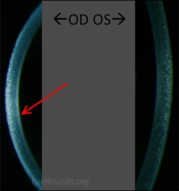 Comparison of slit lamp photo of cornea: Subtle "hammered silver" irregularities OD compared to the normal OS. 