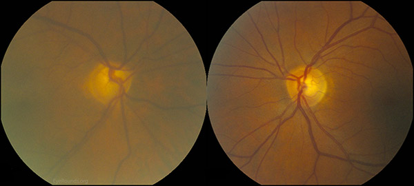 Color fundus photos: There is marked enlargement and progression of the cup-to-disc ratio in the right eye. The left eye fundus and optic nerve are normal. The cataract OD obscures the view of the posterior pole