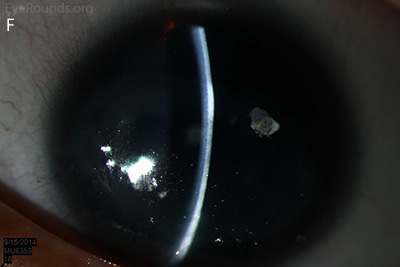 corneal pannus, subepithelial haze, and iris hypoplasia