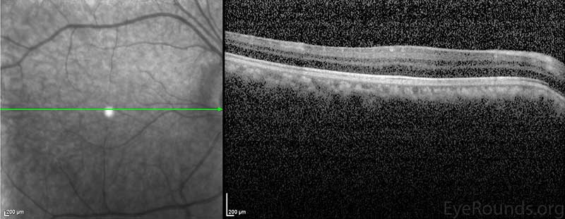 Macular OCT revealed an absence of the normal foveal depression, consistent with foveal hypoplasia