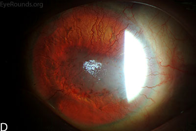 The cataract and corneal scars are demonstrated on retroillumination