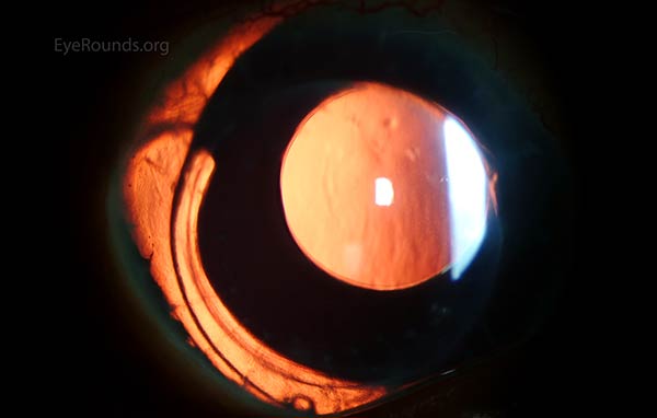 A Morcher intraocular lens in an eye with a full-thickness corneal transplant and traumatic aniridia.