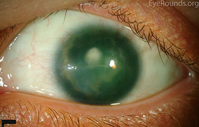 Preoperative appearance of a patient with congenital aniridia and associated cataract