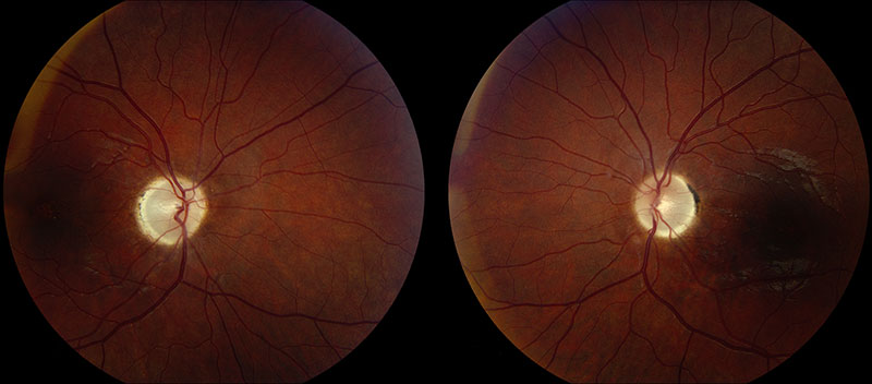 Optic disc pallor is usually seen 6-8 weeks after the initial ischemic event.