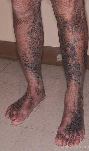 Lower extremity hyperpigmentation