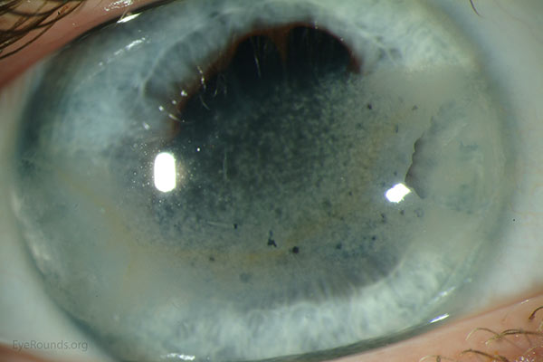 Late band keratopathy secondary to chronic HLA-B27-associated uveitis. The "Swiss cheese" appearance derives from lucent "holes" in the calcific pattern due to corneal nerve penetration through Bowman's layer. 