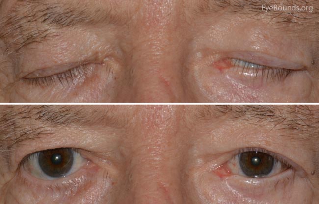 A. External photograph demonstrating stable lower eyelid position. B. There is persistence of mild lagophthalmos during eyelid closure without corneal exposure.