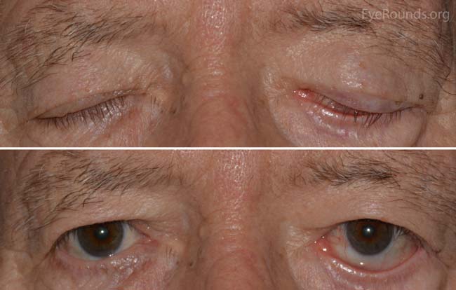 A. External photograph demonstrating left lower eyelid retraction with inferior scleral show. B. There is left lagophthalmos present during eyelid closure.