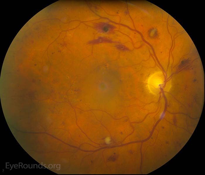 There is moderate vessel tortuosity. The neurosensory retina is detached in the region of the fovea with surrounding macular edema. Numerous focal laser scars are seen inside the arcades. Severe intraretinal hemorrhages are present along the arcades.