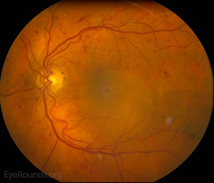 There is mild vessel tortuosity. As in the right eye, there is a neurosensory retina detachment with surrounding macular edema and focal laser scars. There are several macro aneurysms along the arcades in addition to numerous intraretinal hemorrhages.