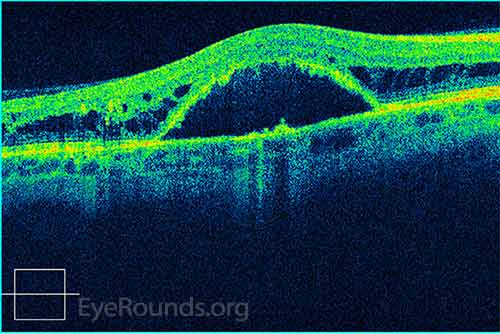 There is a large fovea-involving, serous macular detachment with pockets of overlying intraretinal fluid.