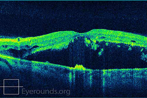 There is a moderately sized fovea-involving, serous macular detachment with minimal intraretinal fluid.