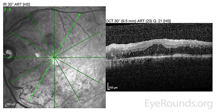 
OS: Resolved neurosensory retinal detachment with diffuse overlying CME.
