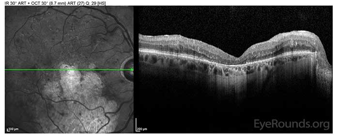 OD: Outer retinal atrophy centrally and inferiorly with mild CME in the superior macula.