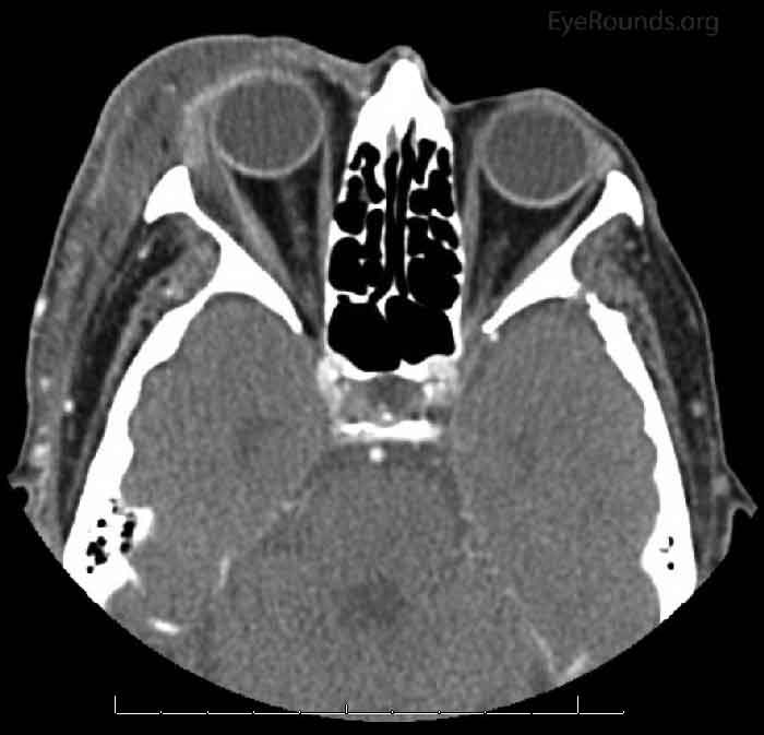 CT maxillo-facial 6 days after onset: Pre- and post-septal inflammatory swelling in the right orbit extending into the extraconal space lateral to the lateral rectus muscle. Proptosis of the right globe. 
