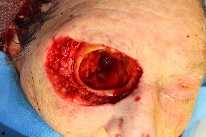 Intraoperative view of the right orbital status post exenteration.