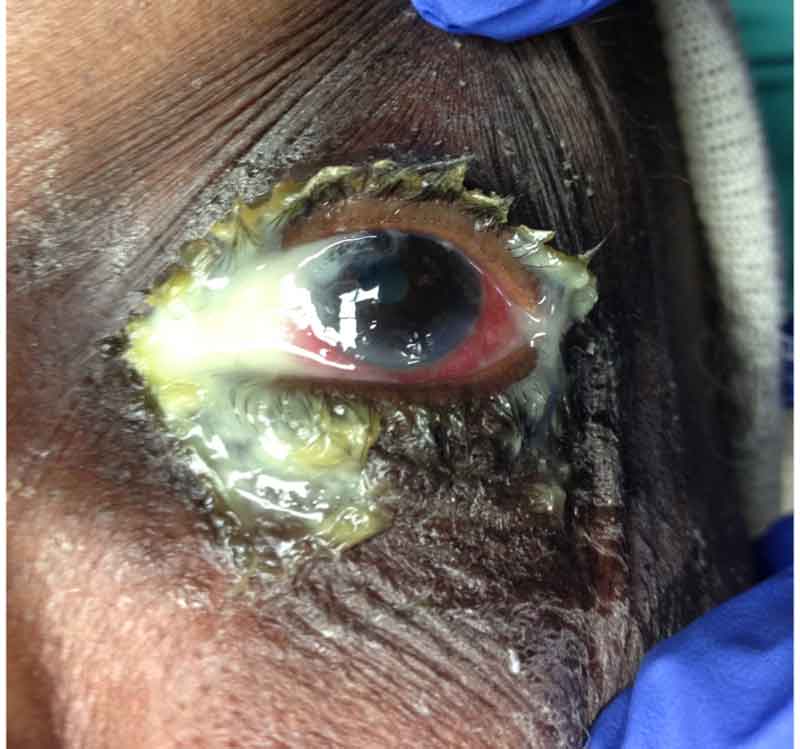 External photograph of the left eye showing copious mucopurulent discharge