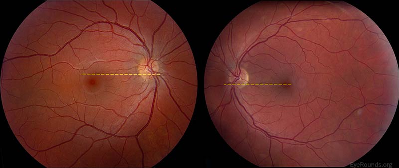 Excyclotorsion of the right fundus. Note that the yellow dashed line drawn horizontally from the inferior 1/3 of the disc in the left (normal) eye intersects the fovea. A line drawn in the same manner in the right eye crosses superior to the fovea. This is an objective sign of fundus excyclotorsion