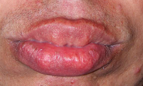 Full appearing lips with thickened mucosa 