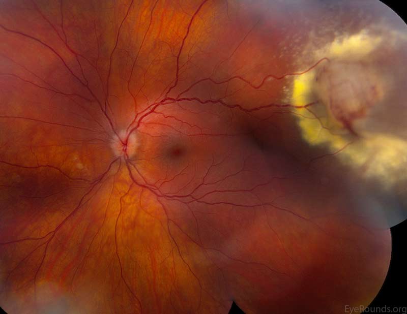 Left eye: Normal macula and vessels. Yellow-white vascular mass in the superotemporal periphery with surface telangiectasia and a feeding arteriole.