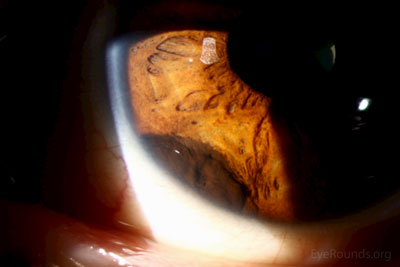 Top right:  On higher power magnification, the lesion appears elevated and the surface of the lesion is mildly irregular without surface vessels and the iris central to the lesion is pushed into folds.