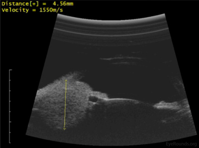 Left:  High-frequency anterior segment ultrasound biomicroscopy revealed a 4.5 (apical height) x 4.9 x 5.3 mm (basal dimensions), oval-shaped, solid lesion of the ciliary body and iris; incidentally, a very small, echolucent iris pigment epithelial cyst is seen.