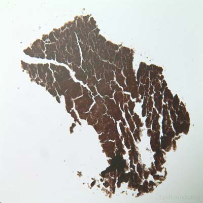Top left:  Low power photomicrograph of the FNAB demonstrates a heavily pigmented tissue fragment.  (Hematoxylin-Eosin stain, original magnification=100x)