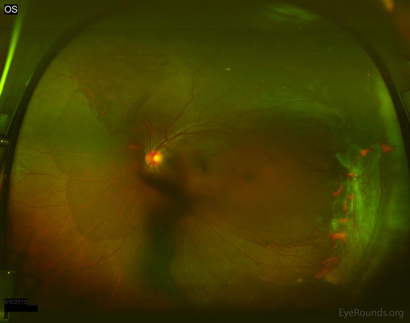 Widefield fundus photo of the left eye demonstrating moderate vitreous hemorrhage overlying the optic nerve. Tractional membrane inferotemporally near the equator with minimal elevation of the retina with associated NVE. White without pressure from 4:00 to 10:00 at the equator.