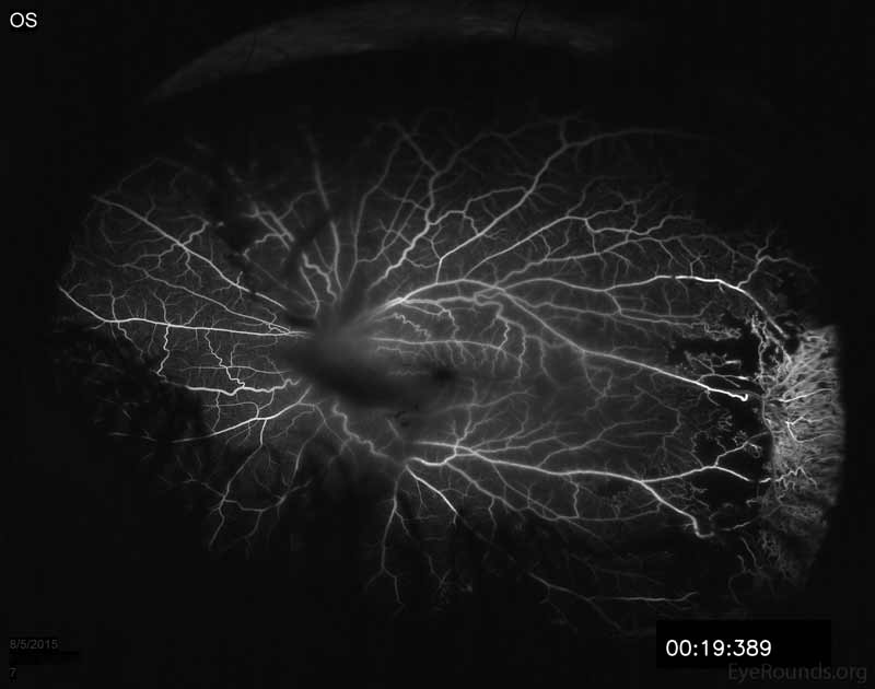 Fluorescein angiogram of the left eye showing hypofluorescence over the disc and macula from overlying vitreous hemorrhage. Note the late leakage from NVE in the superior retina. There is also marked late leakage inferotemporally associated with the NVE and a tractional membrane with adjacent peripheral capillary non-perfusion is visible in the nasal and temporal periphery. 